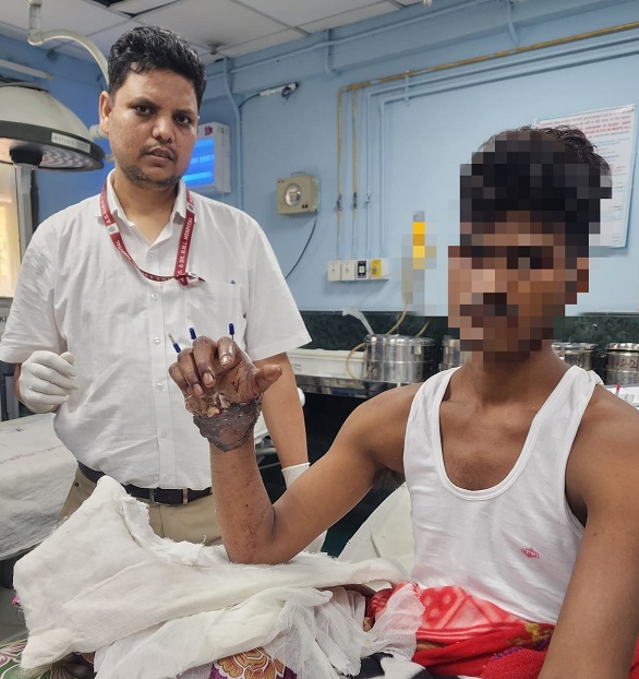 Hand cut by woodcutter machine, joined after surgery, doctors of RML Hospital rejoined the young man's severed hand in a surgery that lasted for nine hours.

