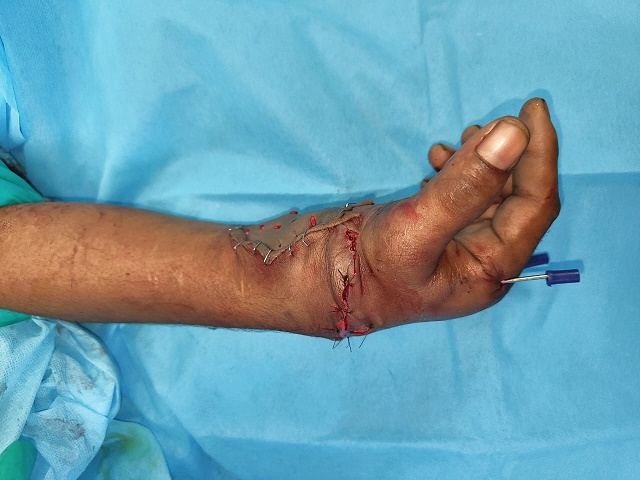 Hand cut by woodcutter machine, joined after surgery, doctors of RML Hospital rejoined the young man's severed hand in a surgery that lasted for nine hours.

