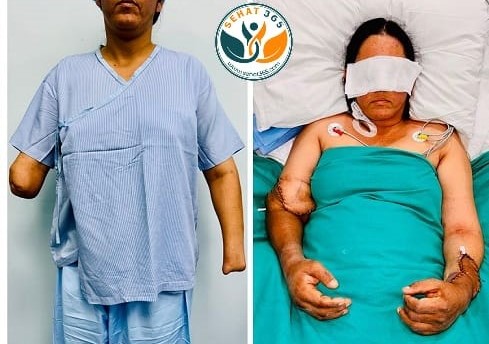 The Department of Plastic, Cosmetic and Hand Microsurgery at Sir Ganga Ram Hospital successfully performed its 2nd bilateral hand transplant on 21st April 2026